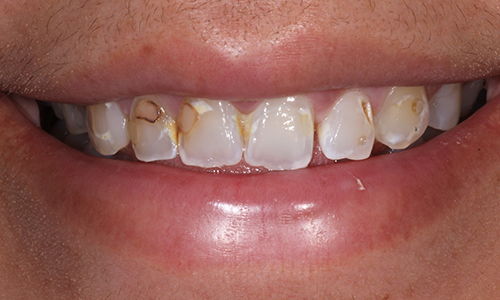 Close-up of teeth with discolored spots