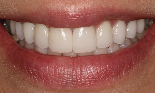 Close-up of Eva's smile after veneers