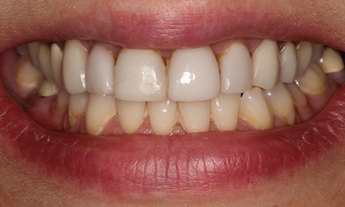 Close-up of Eva's smile before veneers