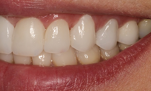 Zoomed in shot of right side of Eva's smile after veneers have been placed