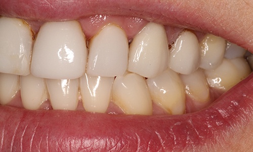 Zoomed in shot of right side of Eva's smile before dental treatment
