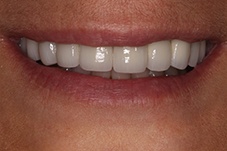 October 2017 dental implant patient front closeup after