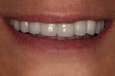 October 2017 dental implant patient front closeup after