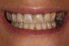 Before Massapequa Park smile makeover