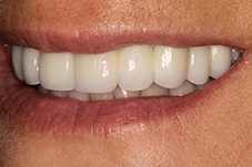 October 2017 dental implant patient side closeup after