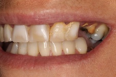 October 2017 dental implant patient side closeup before