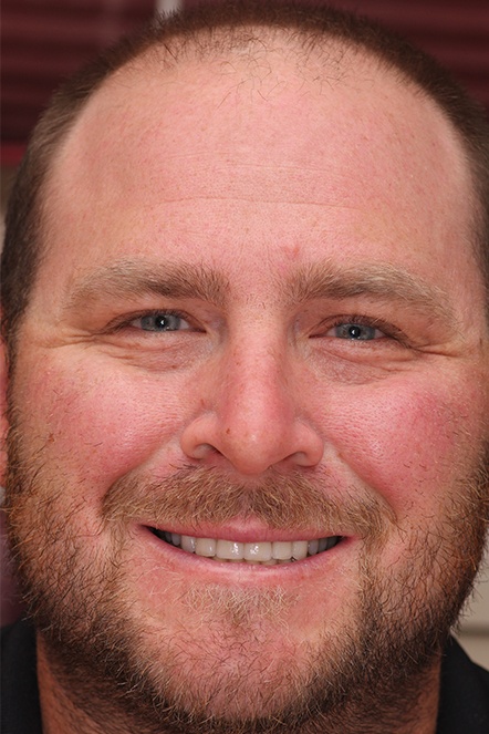 Headshot of bearded man after receiving veneers