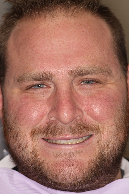 Headshot of bearded man before dental treatment