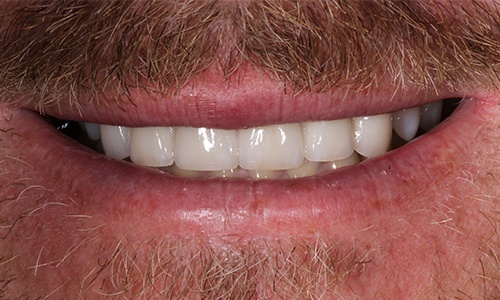 Close-up of smile with veneers hiding discoloration and damage