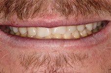 Closeup of Michael before Long Island veneers dental treatment
