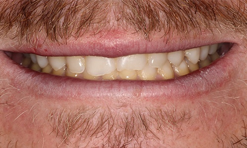 Close-up of damaged and discolored teeth