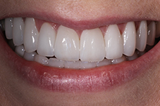 Closeup of Alice after Invisalign braces and veneers