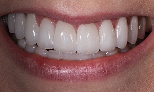 Close-up of smile with veneers correcting multiple imperfections