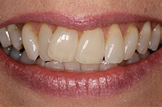 Closeup of Alice before Long Island veneers and Invisalign treatment