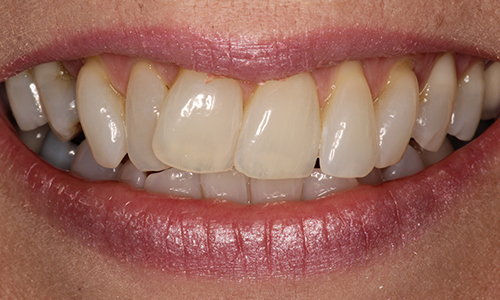 Close-up of smile with overlapping front teeth