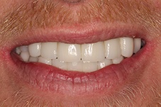 Closeup man with replaced front teeth  after implants