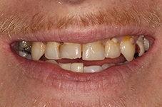 Closeup man with missing front teeth before implants