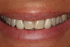 Closeup of Darlene's smile before treatment