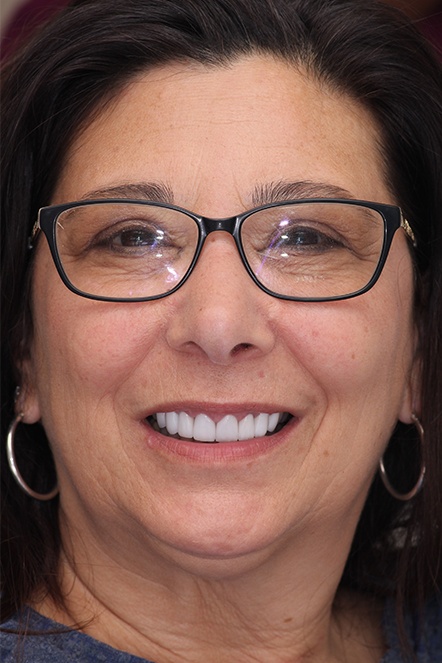 September 2020 gummy smile correction dental patient after treatment