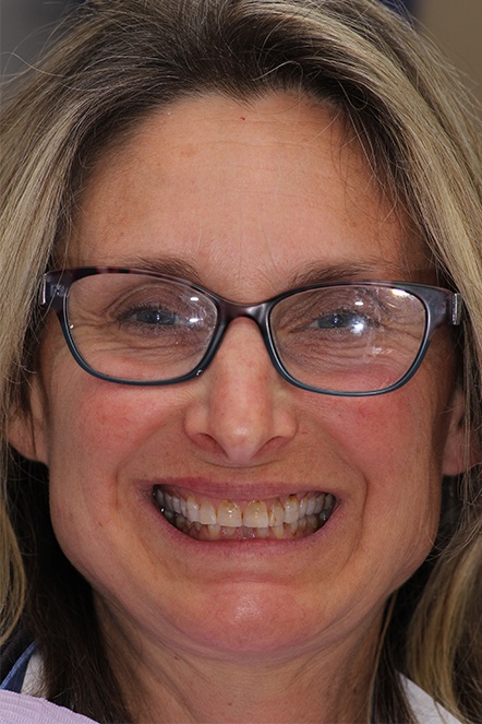 Blonde woman smiling before dental treatment