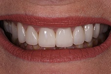 Closeup of Christine after dental crowns and veneers