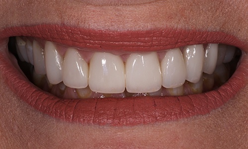Close-up of smile restored with dental crowns