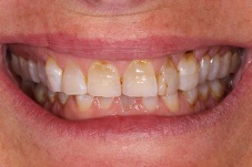Closeup of Christine before Long Island veneers and dental cornws treatment