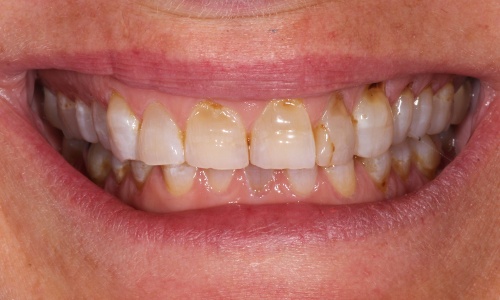 Close-up of smile with multiple unhealthy teeth