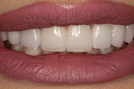 Close-up of smile after receiving dental implant crowns and bridges