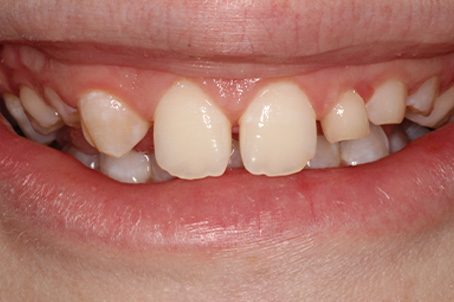 Close-up of multiple teeth that need to be restored and replaced