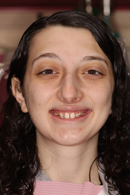 Female patient with smaller than normal teeth