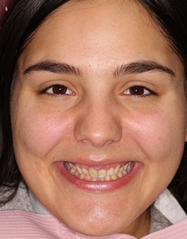 Headshot of Jade with damaged teeth