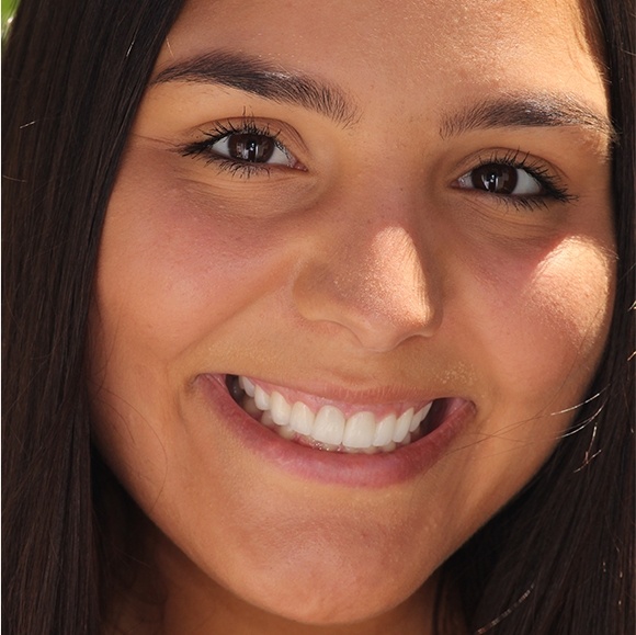 Jade's smile with damaged teeth prior to treatment