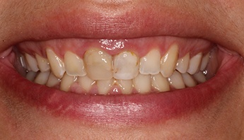 Closeup of Jade before treatment