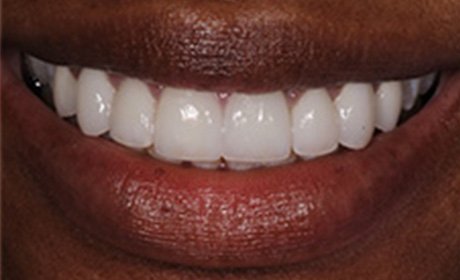 closeup of Kim's beautiful teeth after her cosmetic work