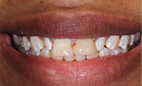 closeup of Kim's yellowed smile before her cosmetic work