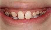 Closeup of woman's teeth before cosmetic dental treatment in Massapequa Park
