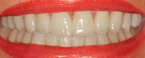Closeup of teeth after smile makeover