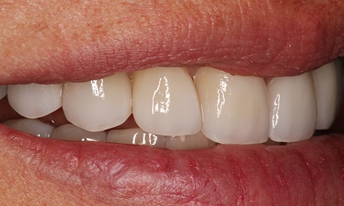 Close-up of tooth with chip hidden with veneers
