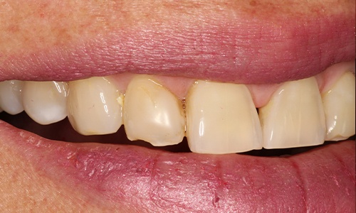 Close-up of chipped tooth on left side of smile