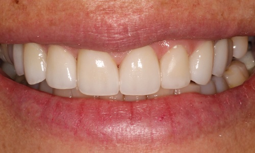 Close-up of Minnie's smile after veneers