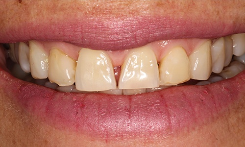 Close-up of Minnie's smile before veneers