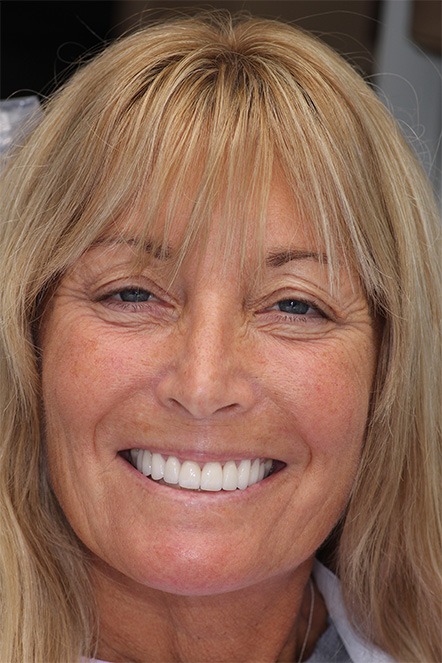 Theresa smiling after receiving veneers