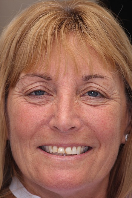Theresa smiling prior to receiving veneers