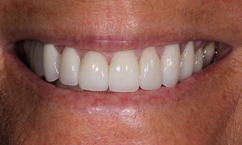 Theresa's whiter teeth after treatment