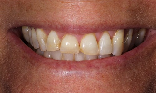 Theresa's discolored teeth before treatment