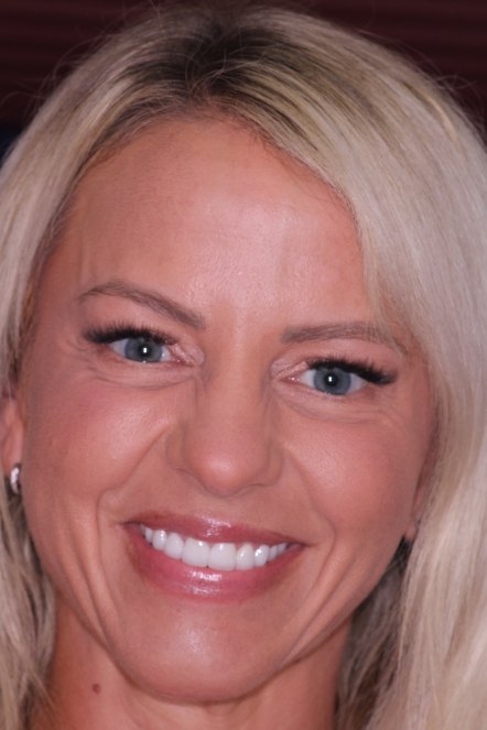 Blonde female patient with ponytail after smile makeover