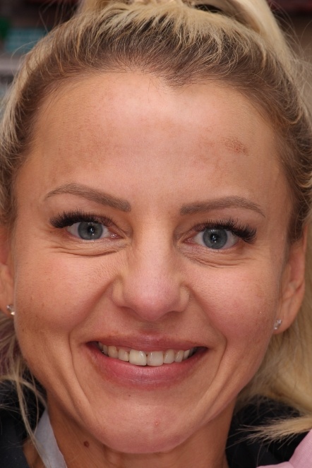 Blonde female patient with ponytail before smile makeover