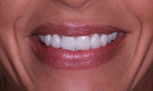 Whiter teeth that are more uniformly sized