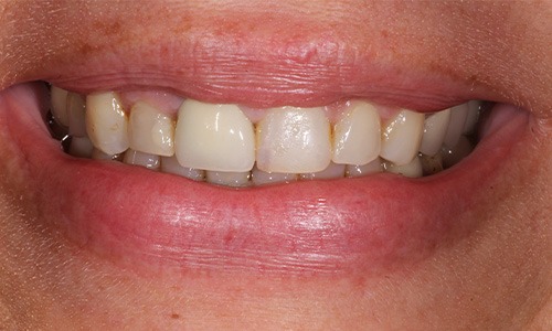 Close-up of discolored, differently sized teeth before treatment